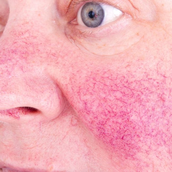 Cuperosis/Rosacea/Rojeces