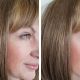 dhbelleza-resultados-flacide-facial-3