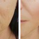 dhbelleza-resultados-flacide-facial-4