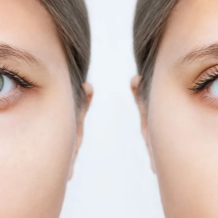 Blefaroplastia sin cirugía